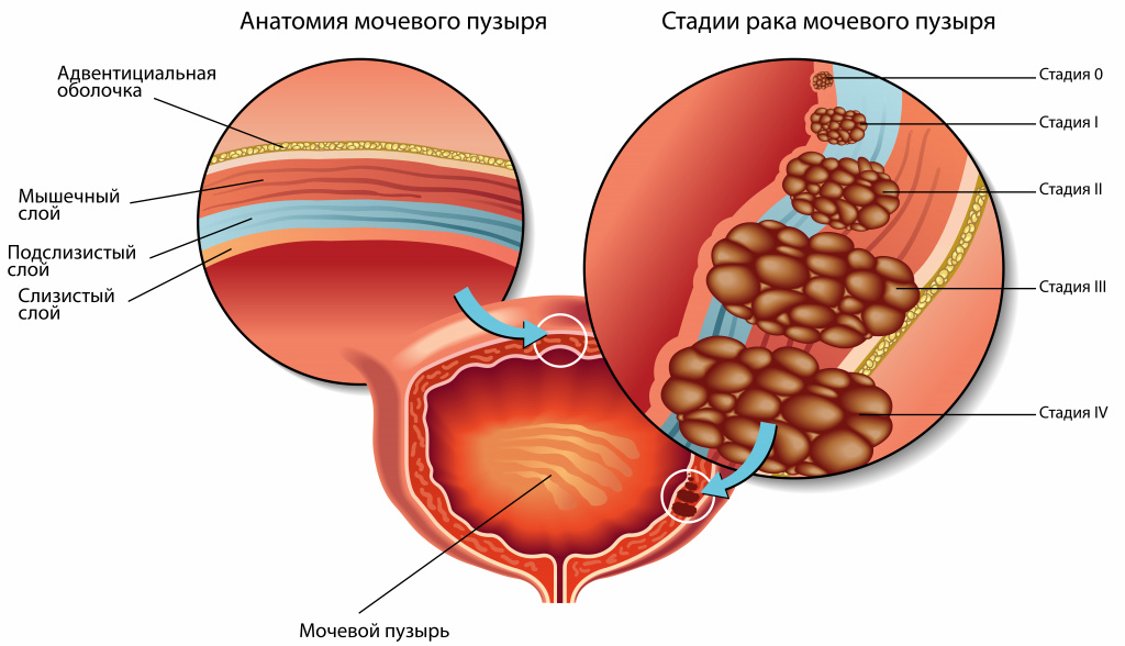 Нейрогенный мочевой пузырь: лечение